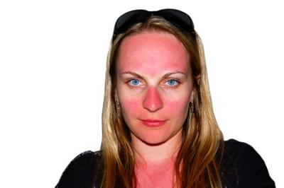 comment reconnaitre un coup de soleil 2