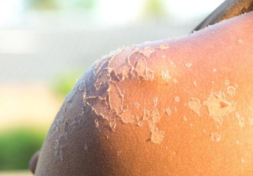 comment reconnaitre un coup de soleil 4