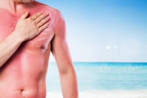 comment reconnaitre un coup de soleil 0